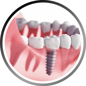 Dental-Implants-01-1024x1024